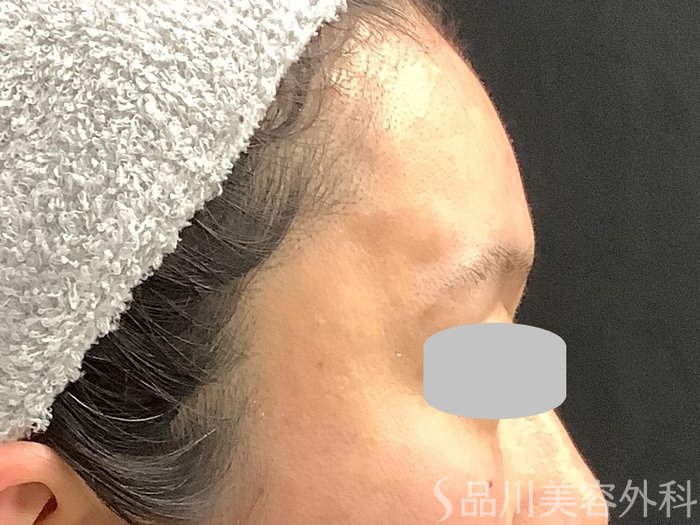 症例NO.67761のAFTER写真