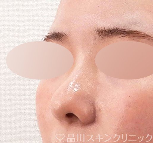 症例NO.62702のAFTER写真