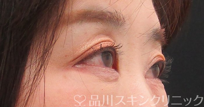 症例NO.75301のAFTER写真