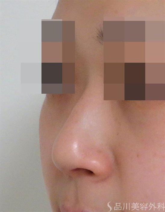 症例NO.47180のBEFORE写真