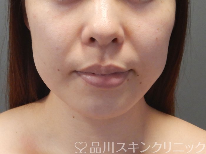 症例NO.71856のBEFORE写真