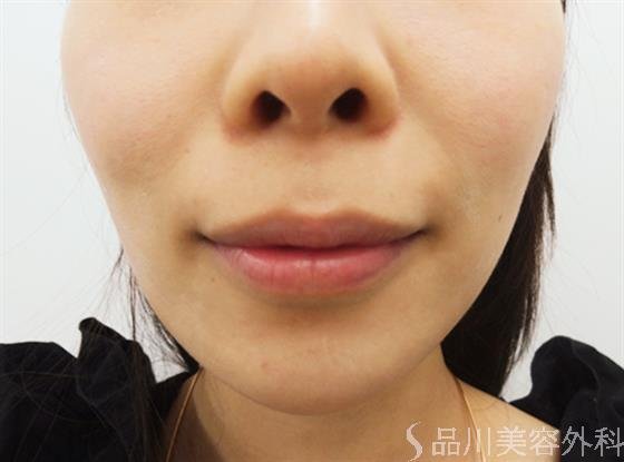 症例NO.31944のBEFORE写真