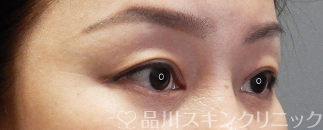 症例NO.73276のBEFORE写真