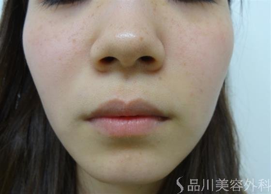 症例NO.25954のAFTER写真