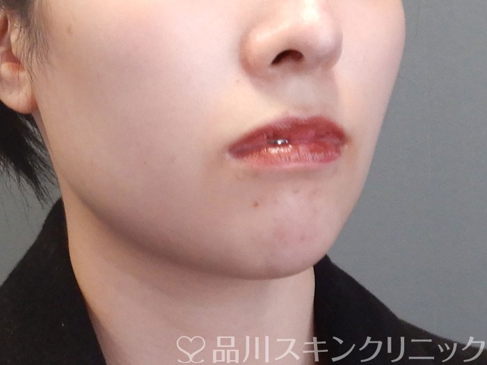 症例NO.72980のBEFORE写真