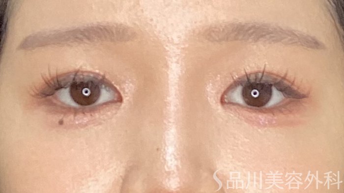 症例NO.71799のAFTER写真