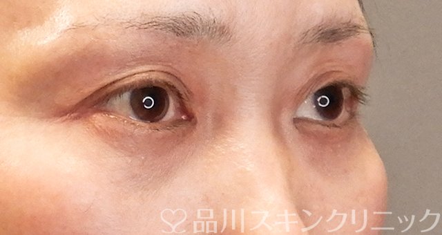 症例NO.63786のBEFORE写真