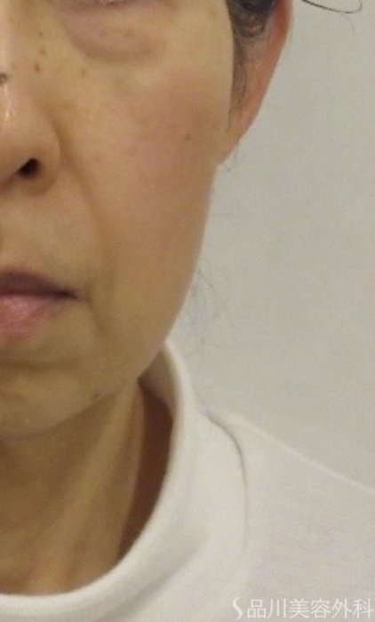 症例NO.75161のBEFORE写真