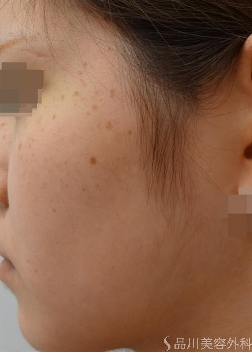症例NO.25954のBEFORE写真