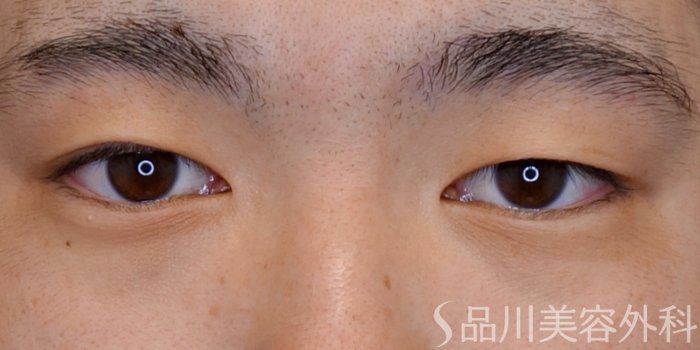 症例NO.73908のBEFORE写真