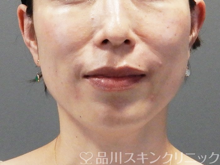 症例NO.74357のAFTER写真
