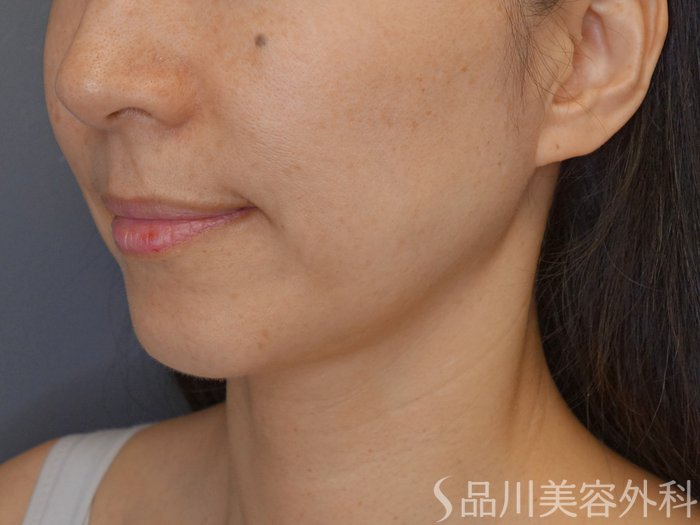 症例NO.72044のBEFORE写真