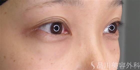 症例NO.47601のBEFORE写真