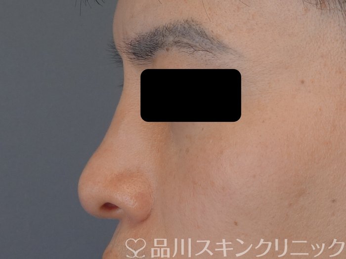 症例NO.74675のBEFORE写真