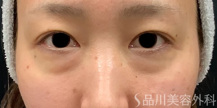 症例NO.69662のBEFORE写真