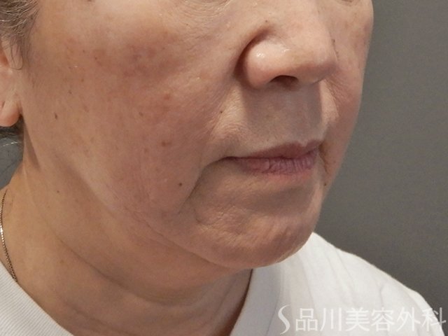 症例NO.73851のBEFORE写真