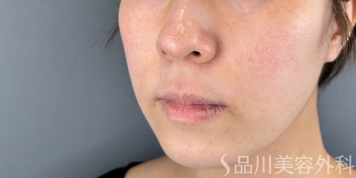 症例NO.71960のBEFORE写真