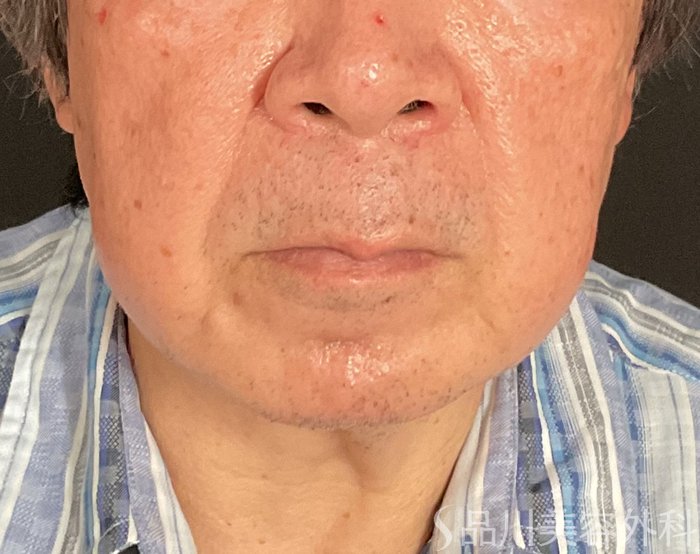 症例NO.74598のBEFORE写真