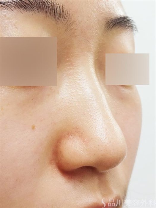 症例NO.33249のBEFORE写真