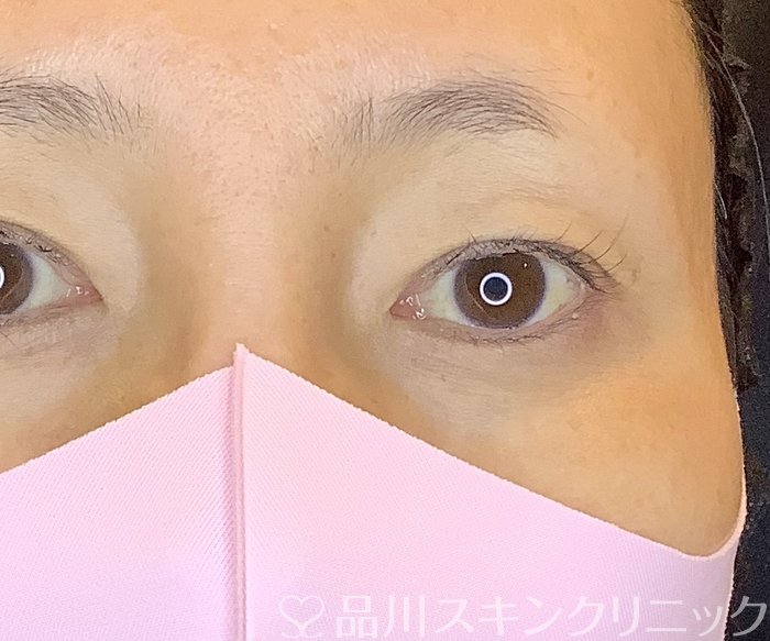 症例NO.65381のBEFORE写真