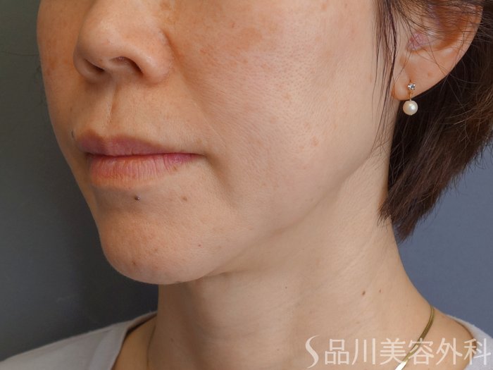 症例NO.72471のBEFORE写真