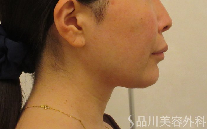 症例NO.71760のBEFORE写真