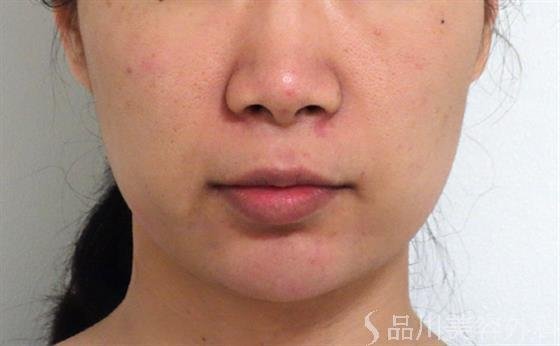 症例NO.35168のBEFORE写真