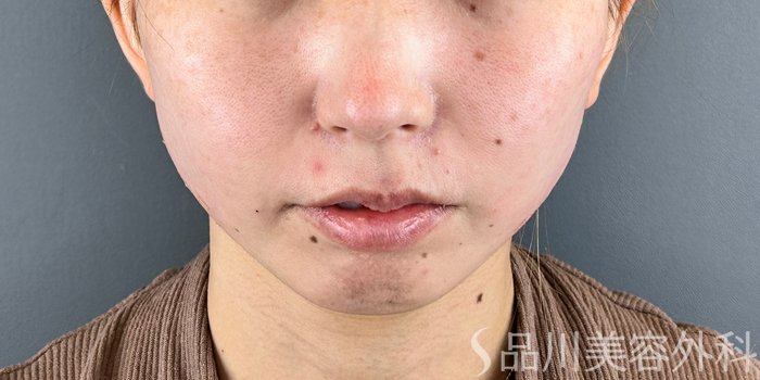 症例NO.71961のAFTER写真