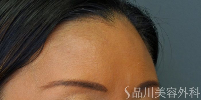 症例NO.71584のBEFORE写真