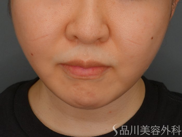 症例NO.73754のAFTER写真