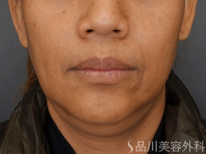 症例NO.72276のBEFORE写真