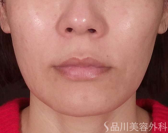 症例NO.69275のBEFORE写真