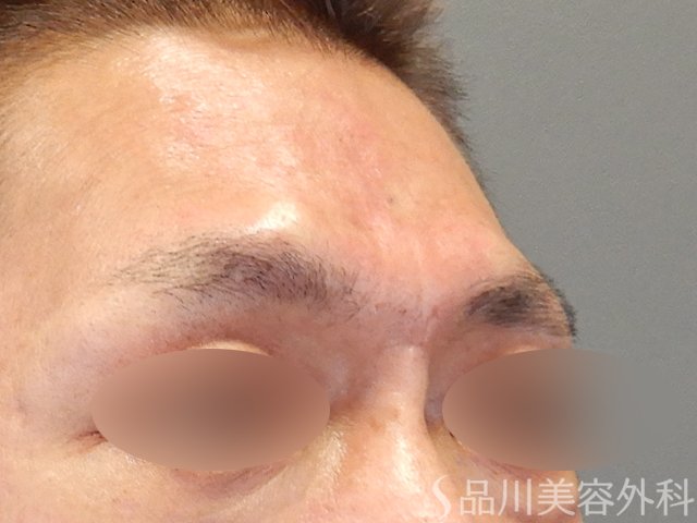 症例NO.75248のAFTER写真