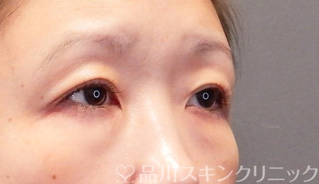 症例NO.75350のBEFORE写真