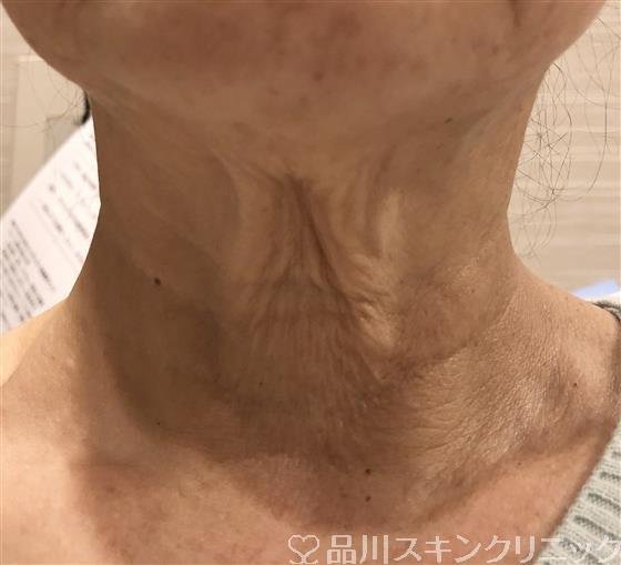 症例NO.32830のBEFORE写真
