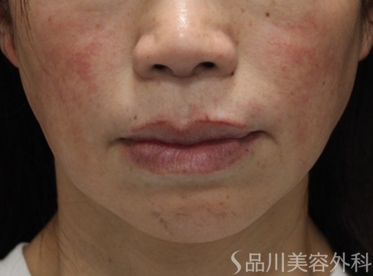 症例NO.75021のBEFORE写真
