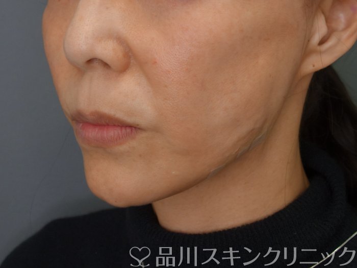 症例NO.74804のAFTER写真