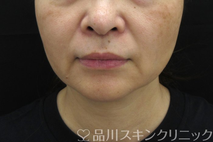 症例NO.74859のBEFORE写真