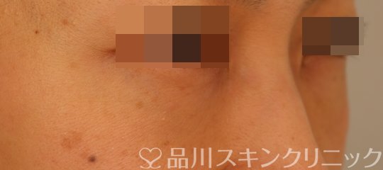 症例NO.72400のAFTER写真