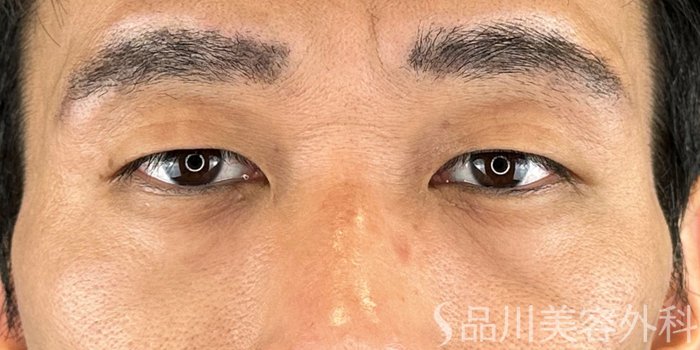 症例NO.70620のBEFORE写真