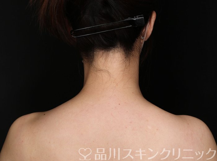 症例NO.67821のBEFORE写真