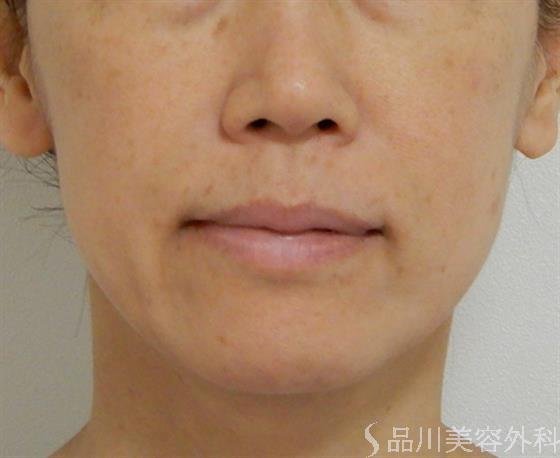 症例NO.38560のBEFORE写真