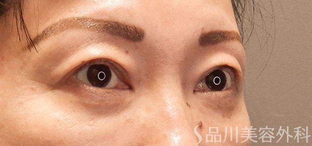 症例NO.73131のAFTER写真