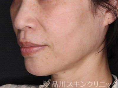 症例NO.74464のBEFORE写真