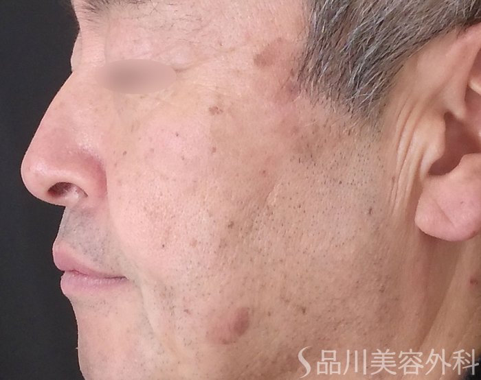 症例NO.70070のBEFORE写真