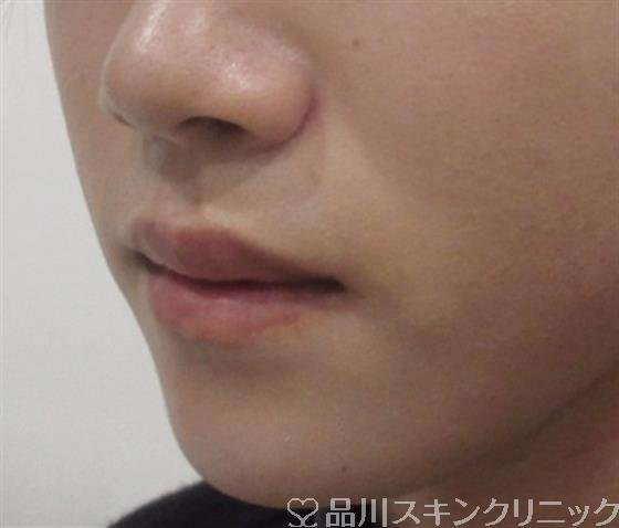 症例NO.30735のAFTER写真