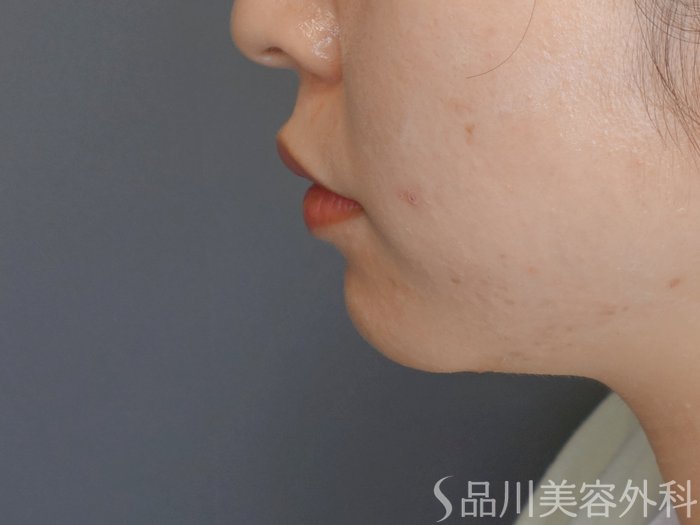 症例NO.70744のBEFORE写真