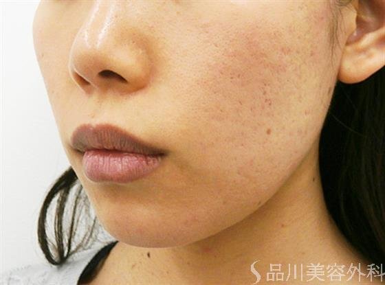 症例NO.24848のAFTER写真