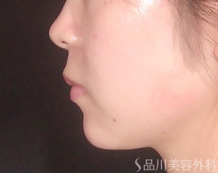 症例NO.70625のAFTER写真