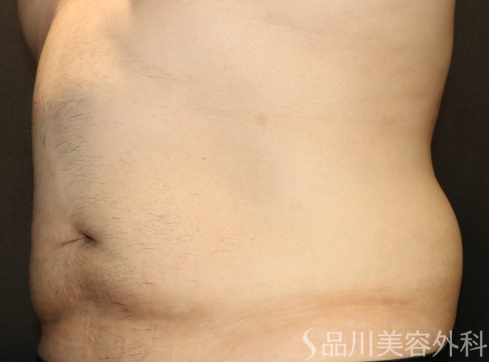 症例NO.74500のAFTER写真